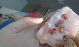 痔疮是属于什么科室,揭秘肛肠科与外科的诊疗奥秘