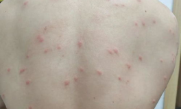 丘疹性湿疹,症状、成因与治疗要点